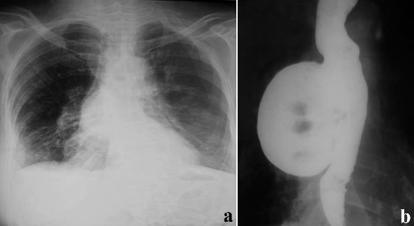 Video Assisted Thoracoscopic Surgery Vats Excision Of Midthoracic